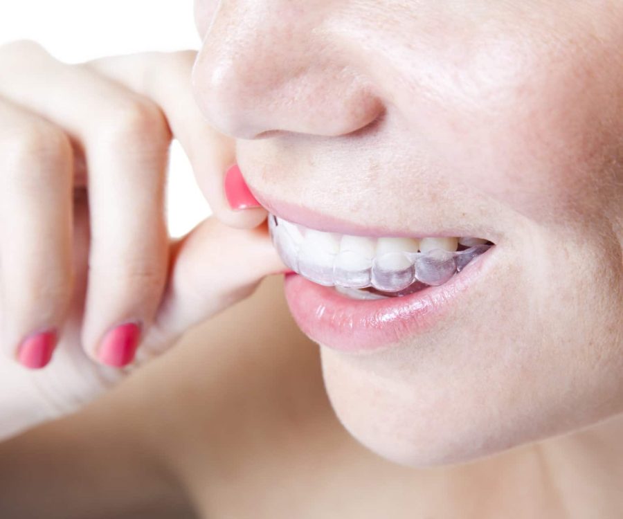 Close-up of young woman wearing clear braces.